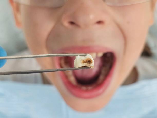 Best Emergency Dental Extractions in Bling, AR
